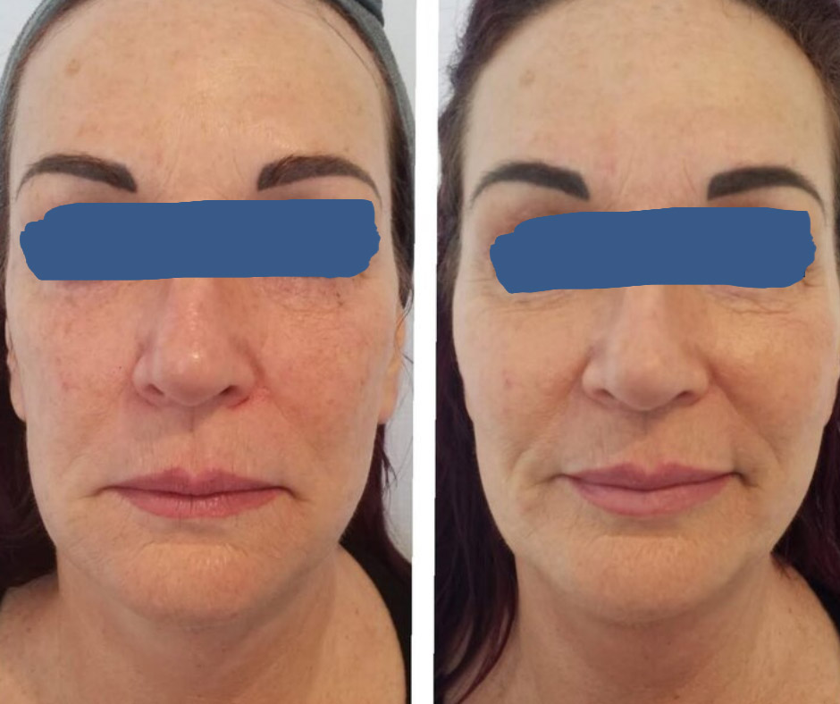 Cheek Fillers To Restore Curvature To The Mid Face
